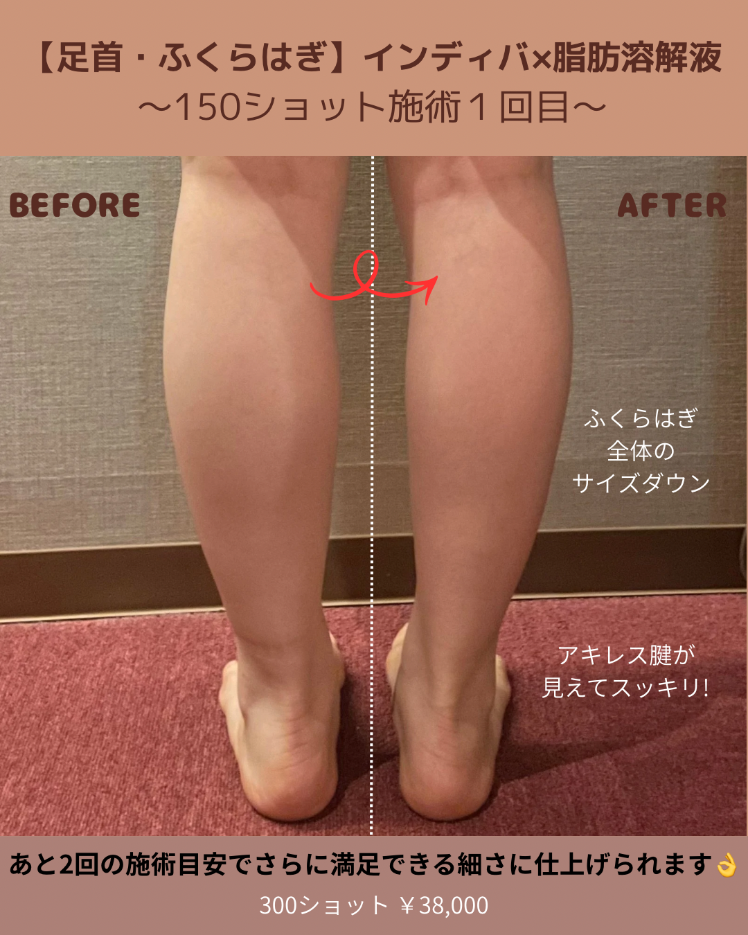 レモンボトル/脱毛/フォトフェイシャル